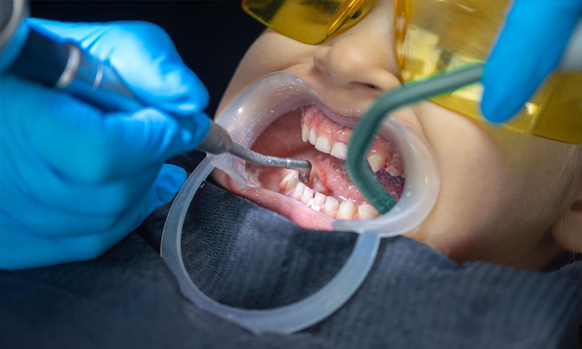 Full Mouth Reconstruction for Bruxism