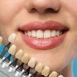 What Are the Differences between Composite Veneers and Prepless Veneers?