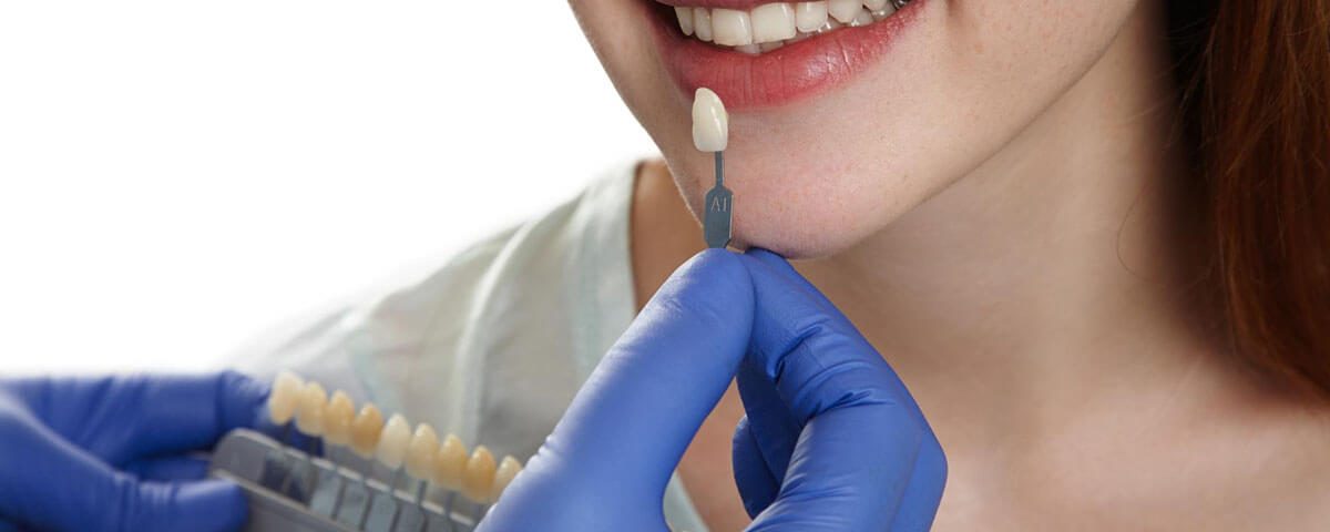 What Are the Key Differences Between No-Prep Veneers and Traditional Veneers?