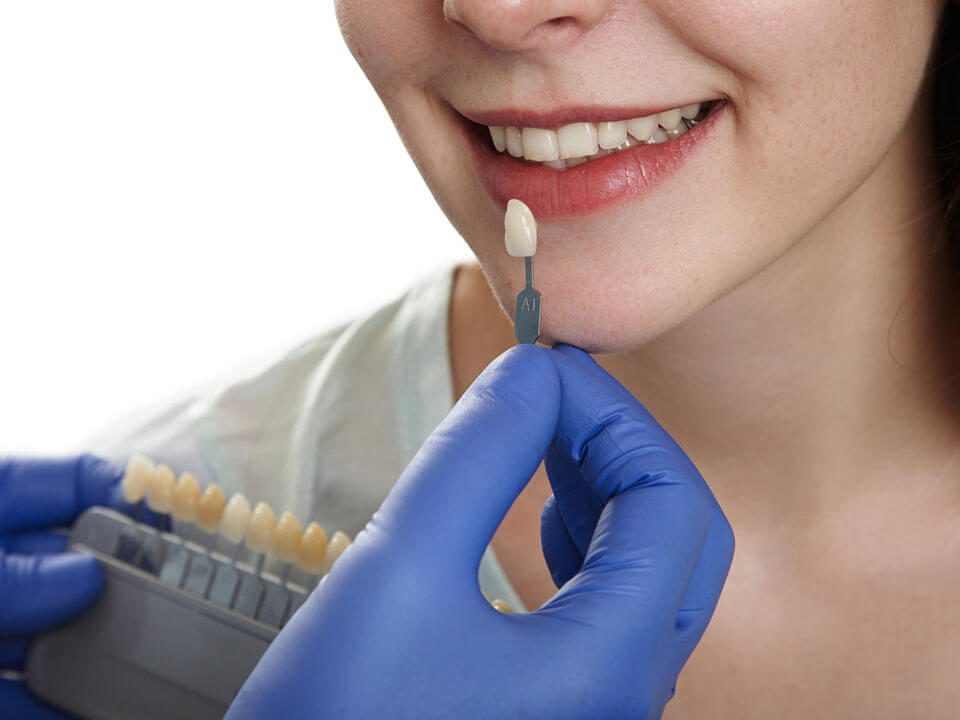 What Are the Key Differences Between No-Prep Veneers and Traditional Veneers?