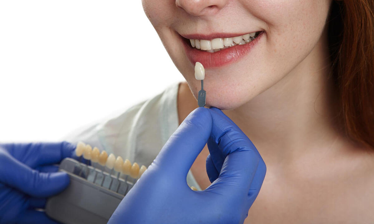 What Are the Key Differences Between No-Prep Veneers and Traditional Veneers?