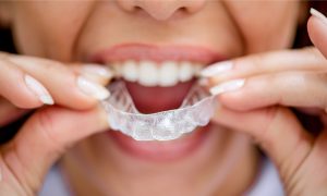Can You Wear Invisalign Only At Night?