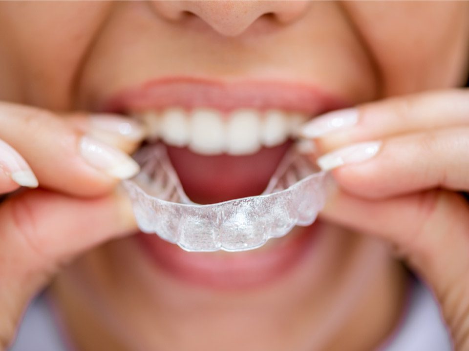 Can You Wear Invisalign Only At Night?