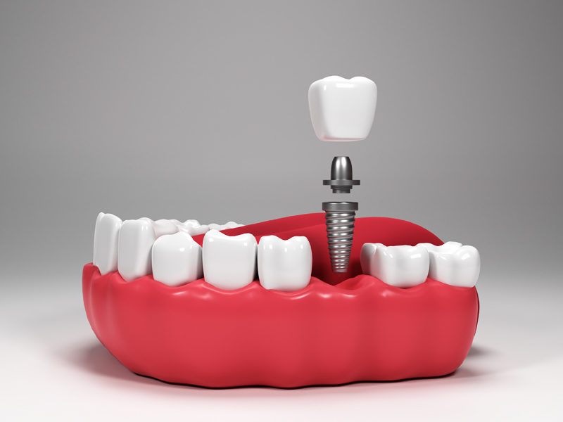 Dental Implants in Ahwatukee, Arizona