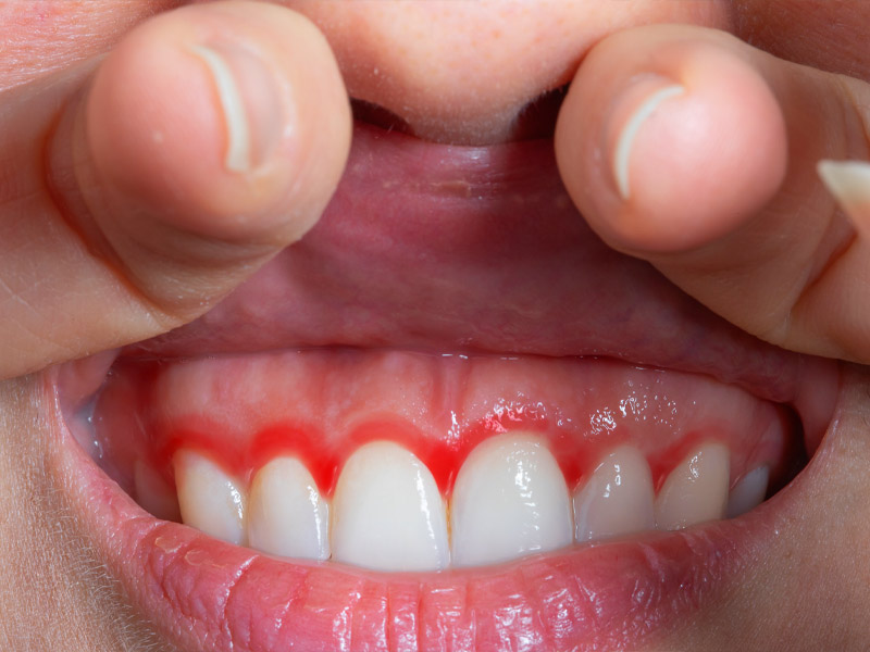 Gum Disease Treatment Phoenix