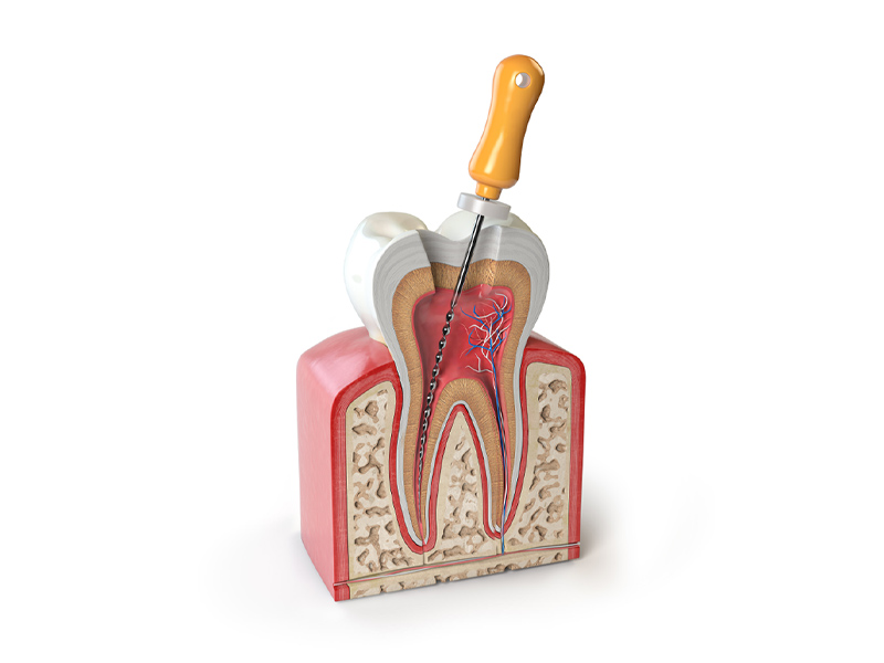 Root Canal Phoenix