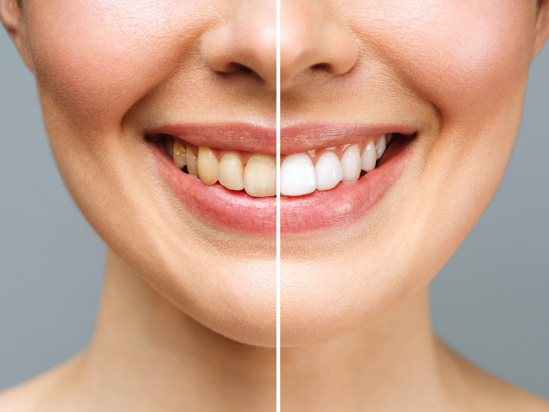 Teeth Whitening in Chandler, AZ