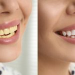 Tooth Discoloration after Root Canal and Its Treatment