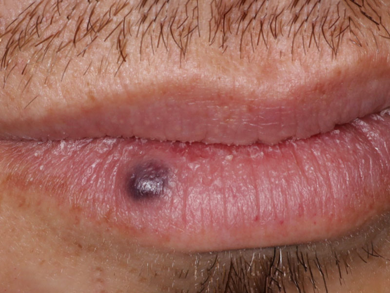 Venous Lakes Lip Treatment in Phoenix
