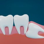 Can Wisdom Teeth Grow Back?