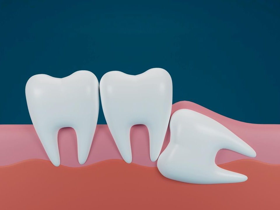 Can Wisdom Teeth Grow Back?
