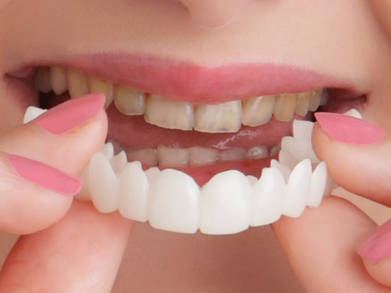 Snap-On Smile in Chandler, AZ