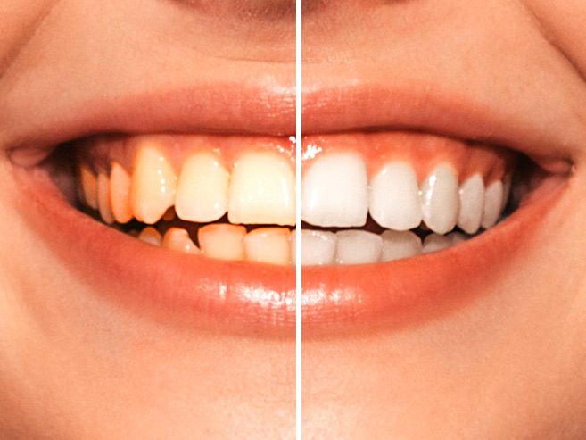 Before After Teeth Whitening Ahwatukee