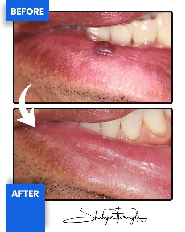 Venous lake Before After