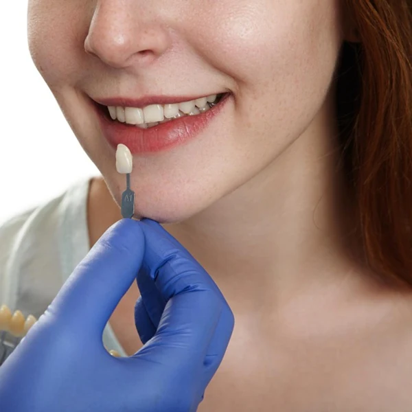 How Much Do Porcelain Veneers Cost in Ahwatukee, AZ?