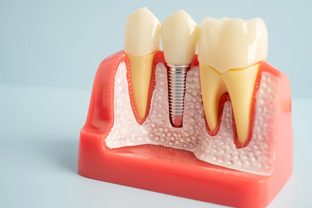 What Is a Dental Implant?