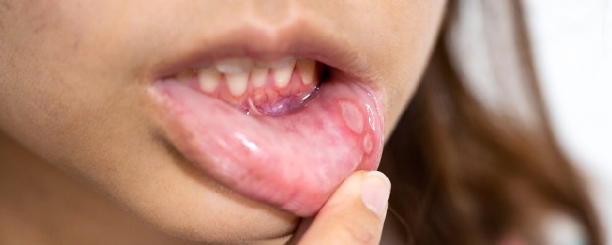 How Much Does It Cost to Treat Oral Fibroma in Phoenix, AZ