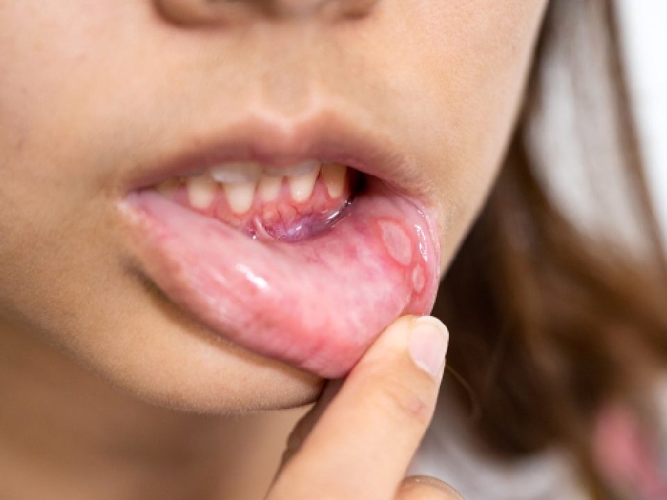 How Much Does It Cost to Treat Oral Fibroma in Phoenix, AZ