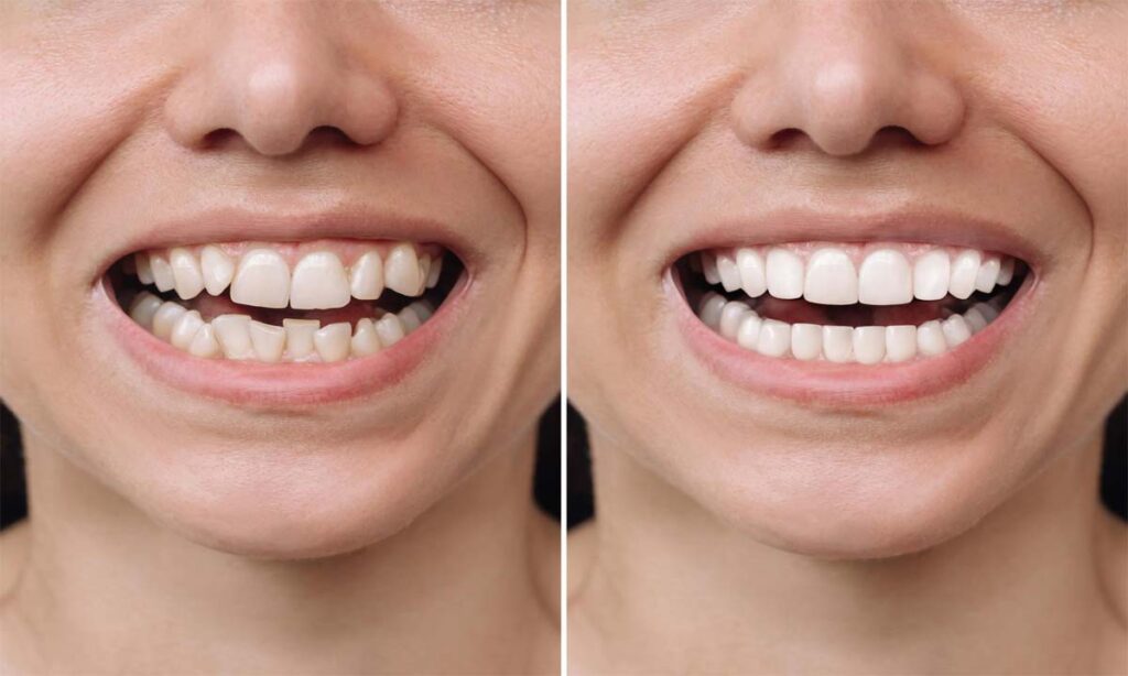 Affordable Smile Makeover before after