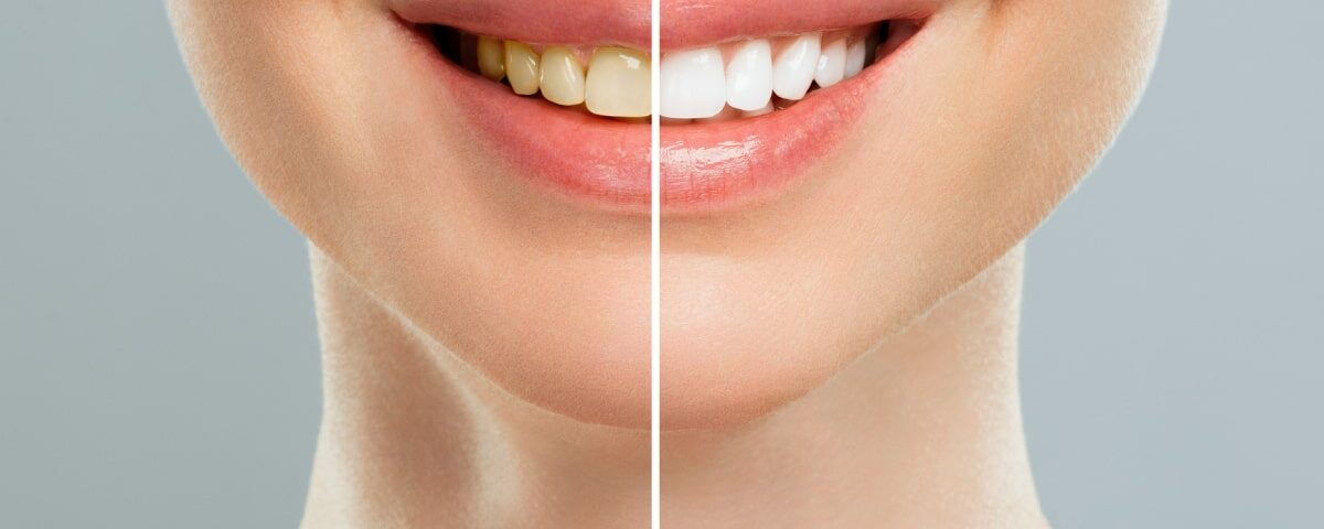 Dental Whitening Cost in Ahwatukee, Phoenix