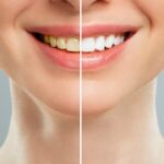 Dental Whitening Cost in Ahwatukee, Phoenix