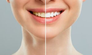Dental Whitening Cost in Ahwatukee, Phoenix