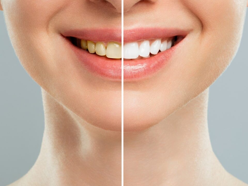 Dental Whitening Cost in Ahwatukee, Phoenix