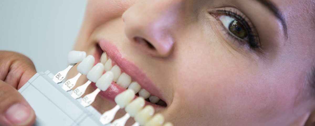 How Much Do Prepless Veneers Cost in Phoenix, AZ