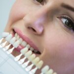 How Much Do Prepless Veneers Cost in Phoenix, AZ