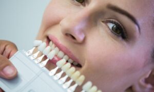 How Much Do Prepless Veneers Cost in Phoenix, AZ