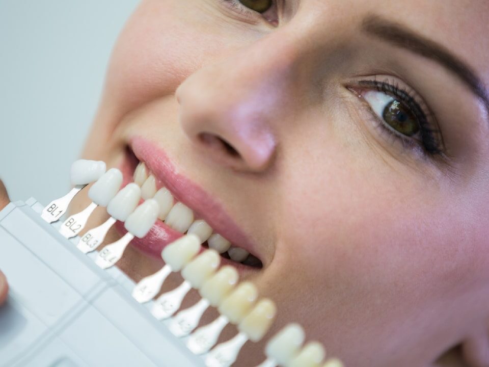 How Much Do Prepless Veneers Cost in Phoenix, AZ