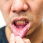 How Much Does It Cost to Remove a Lesion in Ahwatukee, Phoenix