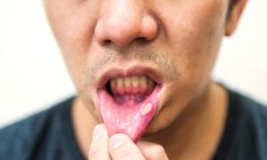 How Much Does It Cost to Remove a Lesion in Ahwatukee, Phoenix