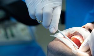 Tooth Extraction Cost in Phoenix