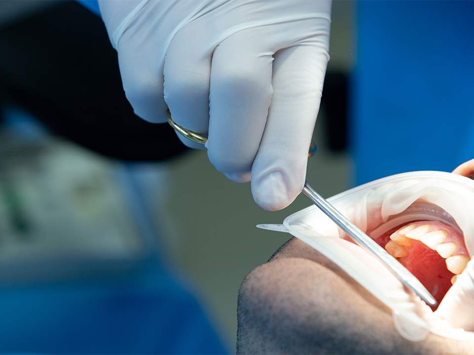 Tooth Extraction Cost in Phoenix