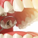 tooth pain without a cavity