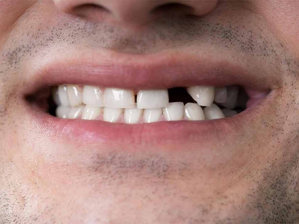 tooth replacement cost in Ahwatukee, AZ