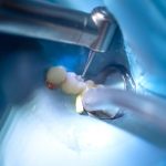 Is Bone Graft Necessary after Tooth Extraction?