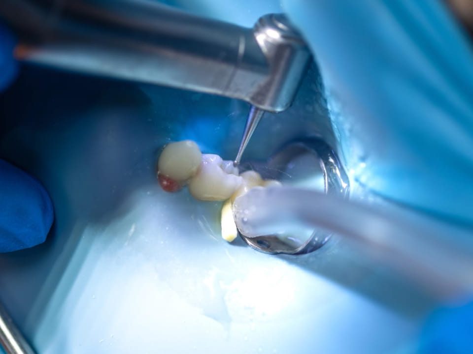 Is Bone Graft Necessary after Tooth Extraction?