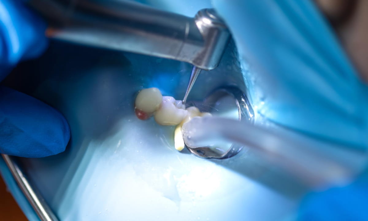 Is Bone Graft Necessary after Tooth Extraction?