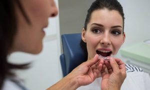 Can Invisalign Fix Severe Cases?