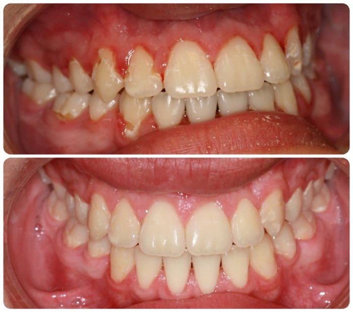 Before After Gingivectomy Treatment in Ahwatukee