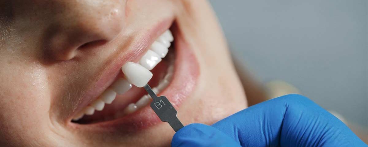 Are You a No Prep Veneers Candidate