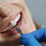 Are You a No Prep Veneers Candidate