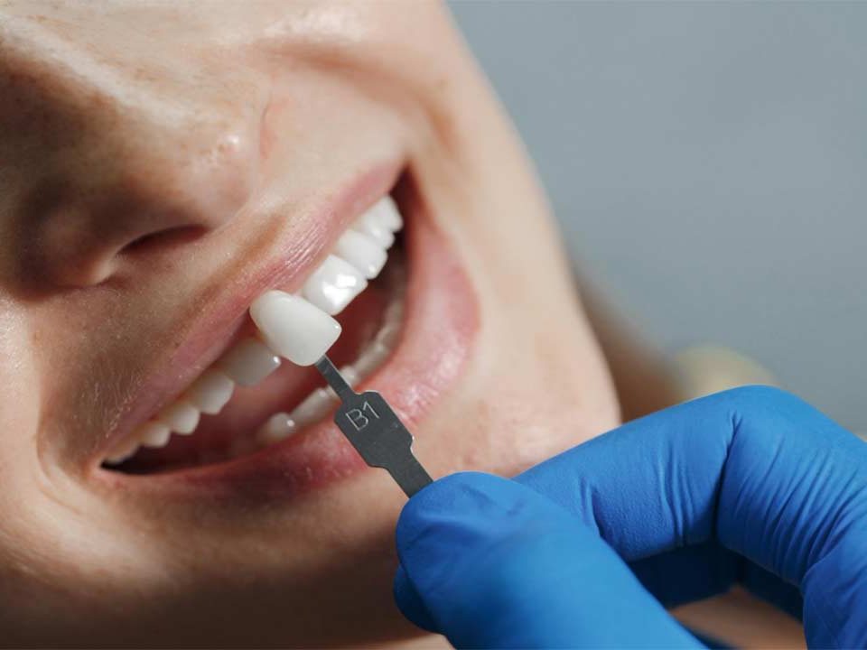 Are You a No Prep Veneers Candidate