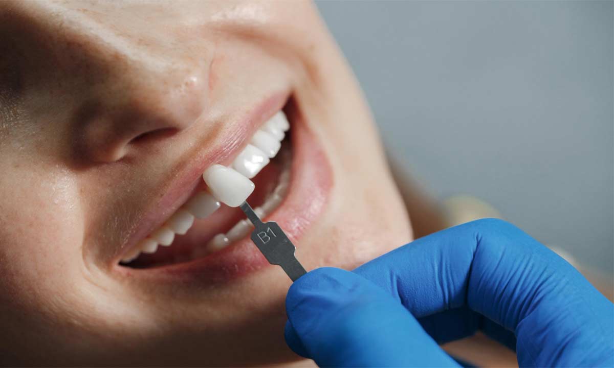 Are You a No Prep Veneers Candidate