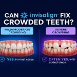 Can Invisalign Fix Crowded Teeth