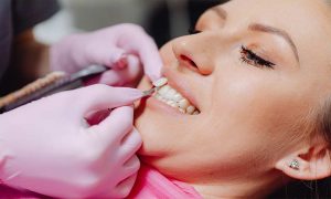 Do Porcelain Veneers Damage Teeth
