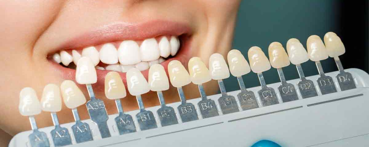 How Long Do Porcelain Veneers Last
