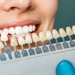How Long Do Porcelain Veneers Last